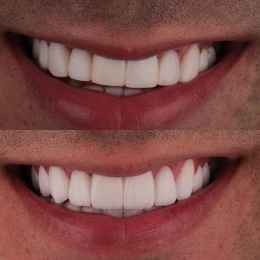Before-and-after smile transformation by Dr. Israel Landa